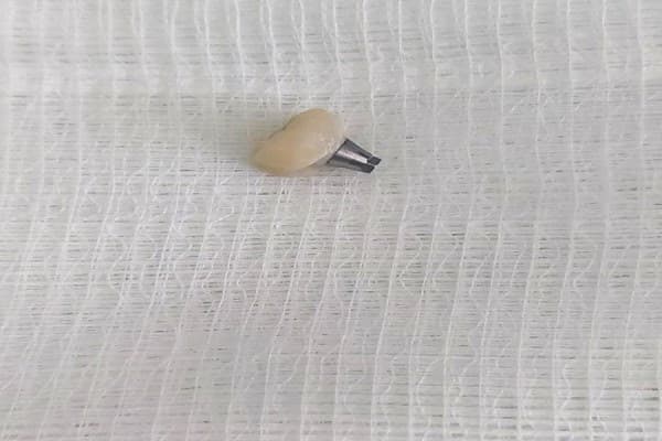 ​Mjekët në Pulmologji i shpëtojnë jetën një personi pasi kishte gëlltitur kurorë dhëmbësh