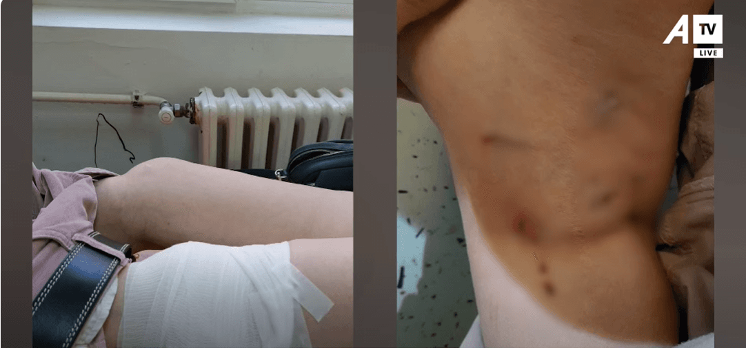 Një 61-vjeçare sulmohet nga qentë endacak në Prishtinë