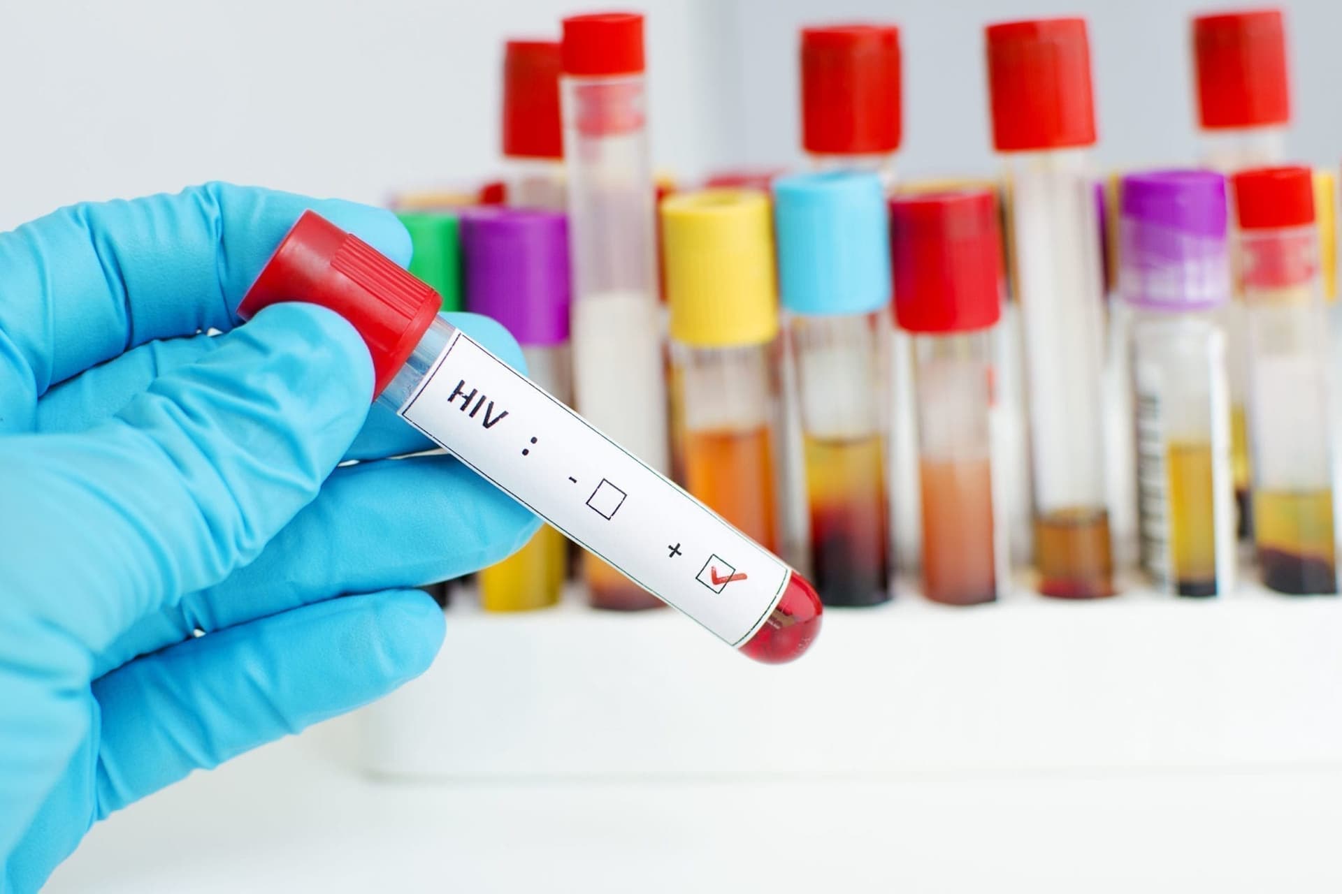 Shkencëtarët janë shumë afër kurës për trajtimin e HIV-it