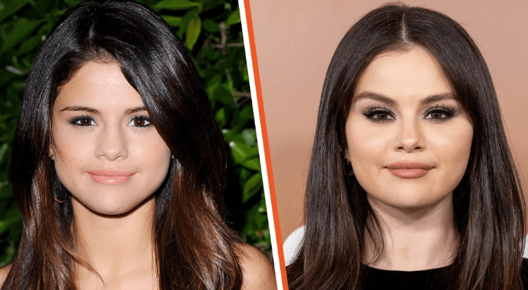 Selena Gomez flet për procedurën e saj të botoksit