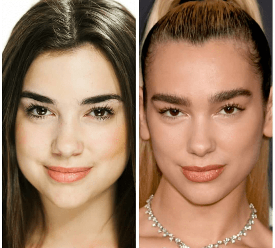 A ka bërë Dua Lipa ndërhyrje estetike?