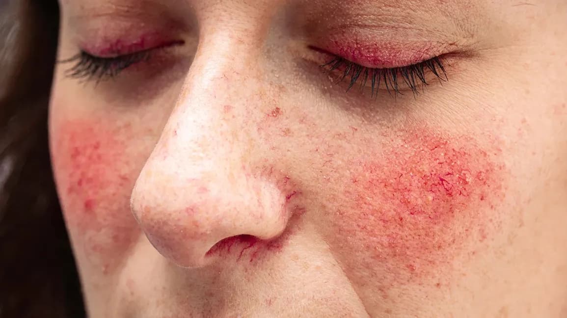 Arsyeja pse skuqja e fytyrës rritet me kalimin e viteve tek personat me rosacea