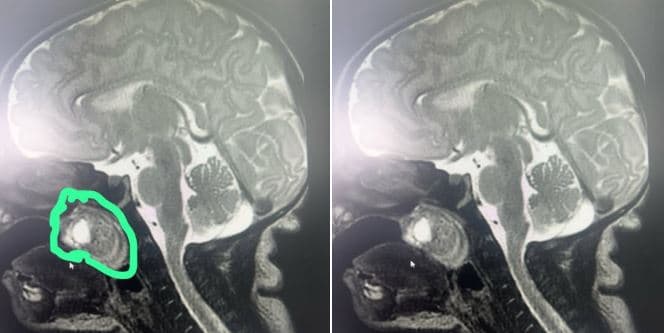 Realizohet me sukses një ndërhyrje e rrallë kirurgjikale, tumori largohet nga foshnja e posalindur