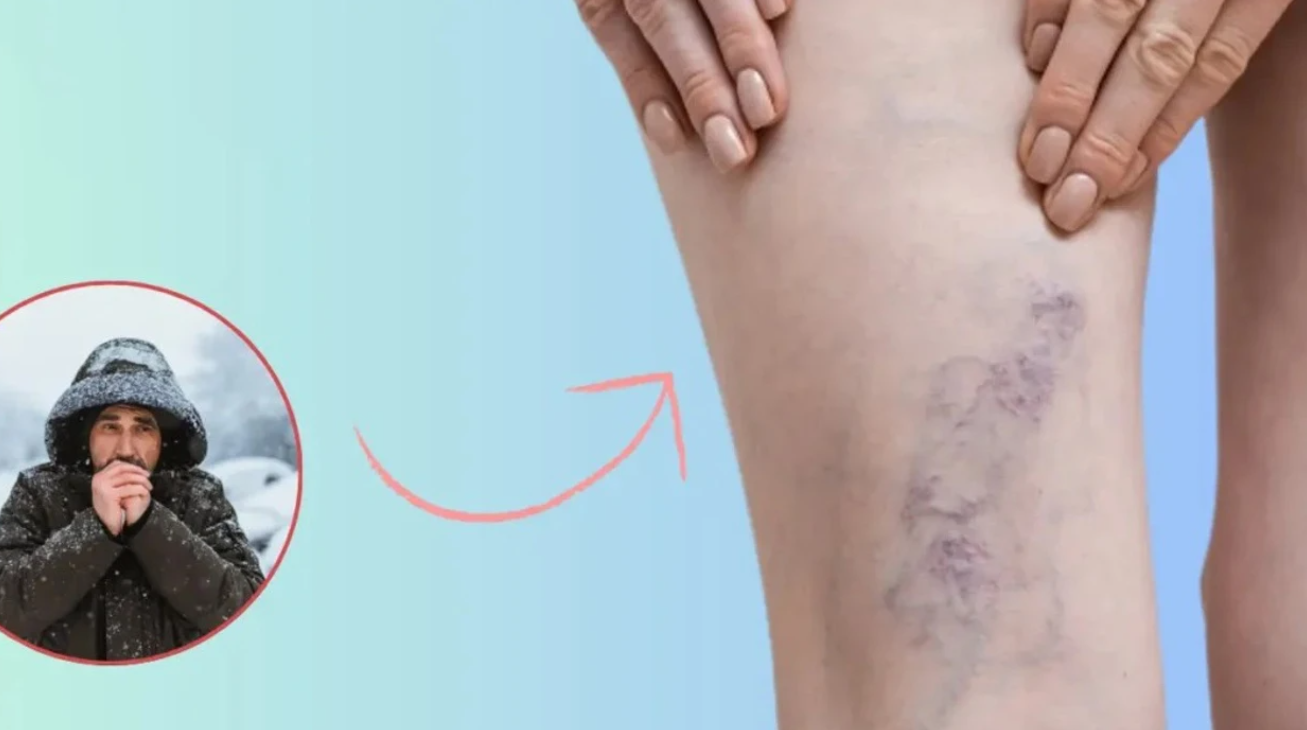 Si ndikojnë të ftohtit dhe kushtet atmosferike në venat dhe cilat simptoma kërkojnë reagim urgjent