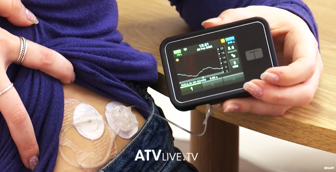  Rreth 2 mijë euro një pompë e insulinës    Kërkohet që pompat e insulinës të sigurohen nga shteti