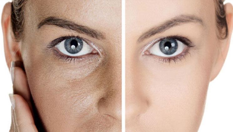 menyra-e-duhur-per-t-i-larguar-poret-nga-fytyra-ne-afat-rekord