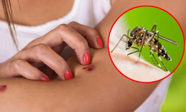 Si të mbroheni nga mushkonjat gjatë ditëve të nxehta 